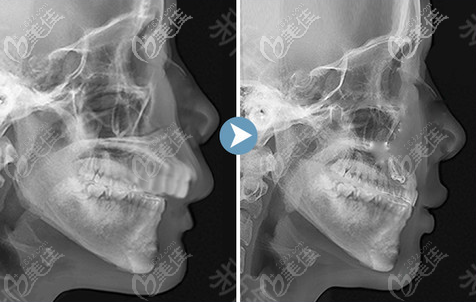 上顎骨突出矯正價格36800-68000元左右