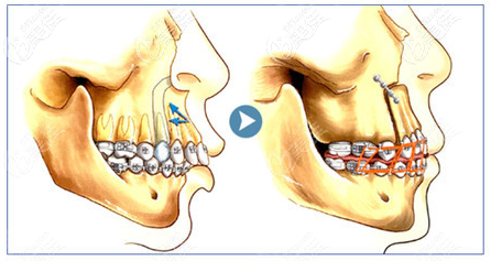上顎骨突出矯正手術(shù)示意圖