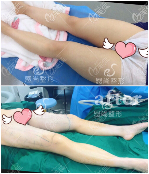 大腿吸脂前后對比案例 大腿吸脂前后對比案例