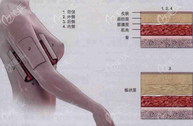 手臂環(huán)吸包含哪幾個部位 手臂環(huán)吸包含哪幾個部位