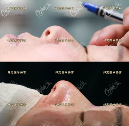 北京張艷華醫(yī)生鼻綜合案例