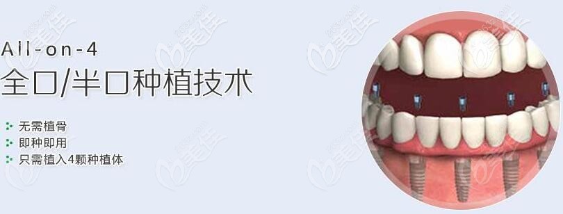 廣州穗江口腔何榮冰allon4種植牙