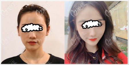 貴陽(yáng)華美趙峰隆鼻案例:恢復(fù)三個(gè)月后鼻子挺翹自然 貴陽(yáng)華美趙峰隆鼻案例:恢復(fù)三個(gè)月后鼻子挺翹自然