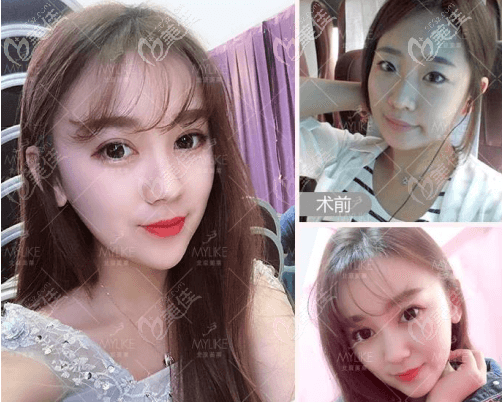 我找北京美萊做鼻子好的牛永敢醫(yī)生做的隆鼻案例