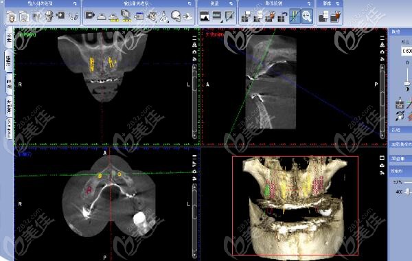 北京牙管家全口牙缺失案例 北京牙管家全口牙缺失案例