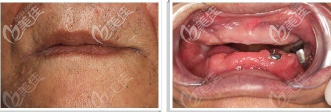 牙管家口腔滿(mǎn)口無(wú)牙案例 牙管家口腔滿(mǎn)口無(wú)牙案例