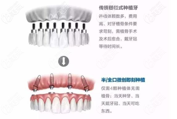 傳統(tǒng)種植牙和即刻種植區(qū)別