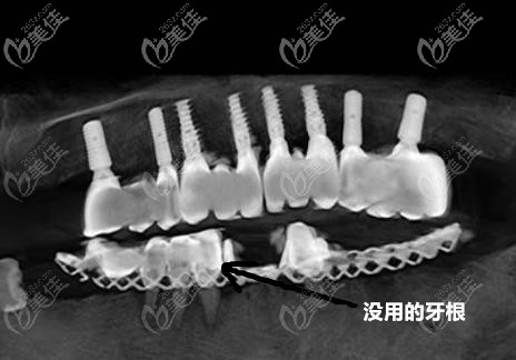 沒有用的牙根需要拔除