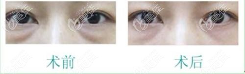 內吸去眼袋前后效果對比