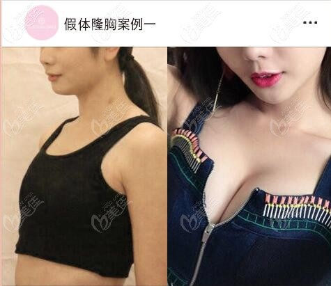 中山伊美神假體隆胸案例 中山伊美神假體隆胸案例