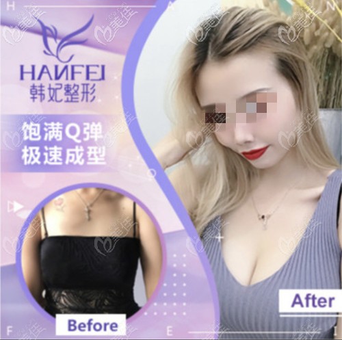 中山韓美假體隆胸案例 中山韓美假體隆胸案例