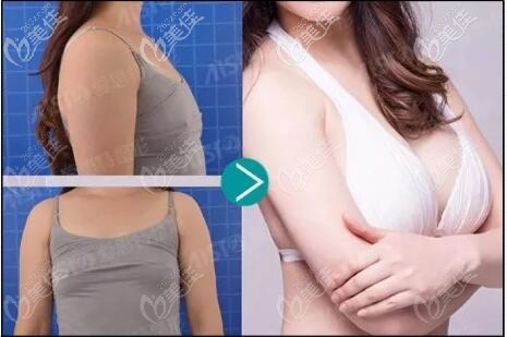 中山愛思特假體隆胸案例 中山愛思特假體隆胸案例