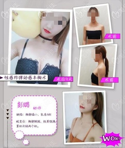 中山尼姬假體隆胸案例 中山尼姬假體隆胸案例