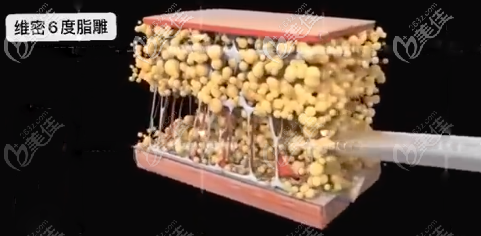 維密6度脂雕吸脂示意圖 維密6度脂雕吸脂示意圖