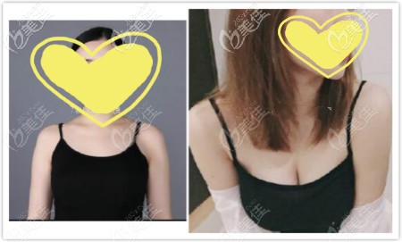 極速果凍豐胸恢復(fù)一年前后對(duì)比圖 極速果凍豐胸恢復(fù)一年前后對(duì)比圖