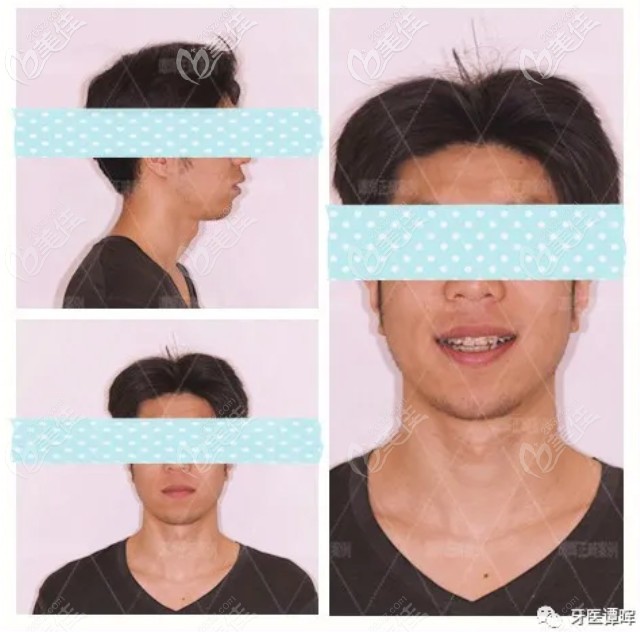 矯正10個月的效果圖