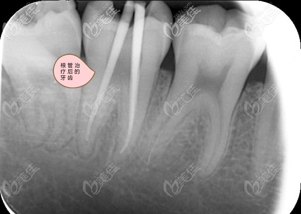 根管治療后的牙齒拍片圖