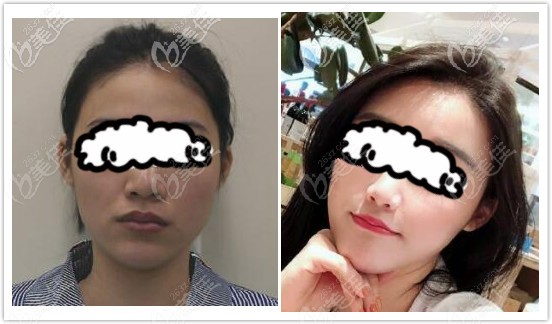 自體脂肪膠填充臉部恢復(fù)半年效果對(duì)比圖 自體脂肪膠填充臉部恢復(fù)半年效果對(duì)比圖