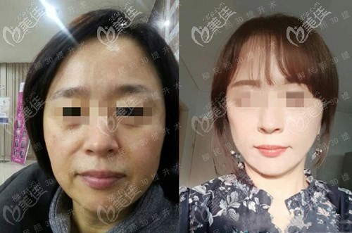 柳民熙3d童顏術(shù)案例 柳民熙3d童顏術(shù)案例