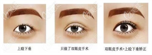 上瞼下垂做提肌和不做提肌的區(qū)別 上瞼下垂做提肌和不做提肌的區(qū)別