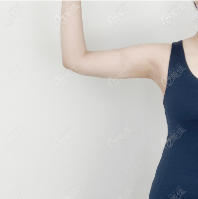 我做手臂吸脂術后十多天恢復圖
