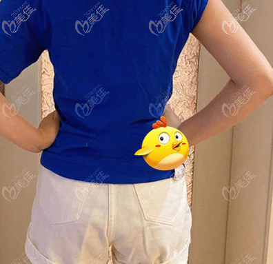 找北京做手臂吸脂好的醫(yī)生陳林葉做完手術有84天了