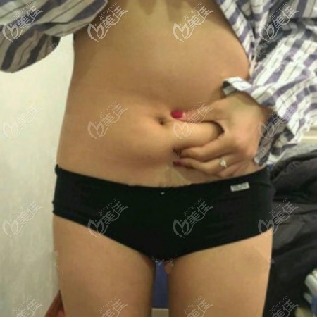 找<!--<i data=20240703-sp></i>-->時(shí)光<!--<i data=20240703-sp></i>-->吸脂前肚子照片 找<!--<i data=20240703-sp></i>-->時(shí)光<!--<i data=20240703-sp></i>-->吸脂前肚子照片