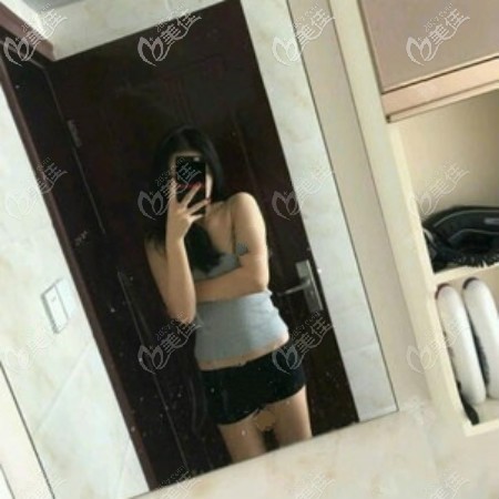 肚子吸脂15天恢復(fù)效果圖:半個(gè)月了一點(diǎn)沒(méi)效果 肚子吸脂15天恢復(fù)效果圖:半個(gè)月了一點(diǎn)沒(méi)效果