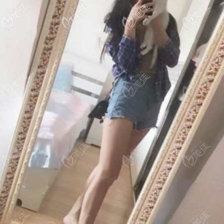 我肚子吸脂半個月了一點效果也沒有,3個月后量了下腰圍瘦了12厘米