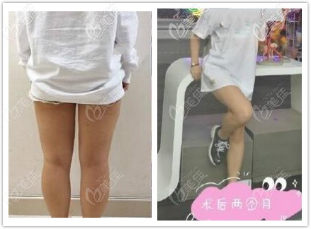 大腿吸脂三個月腿圍細了10厘米 大腿吸脂三個月腿圍細了10厘米