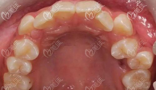 牙齒重度擁擠的圖片