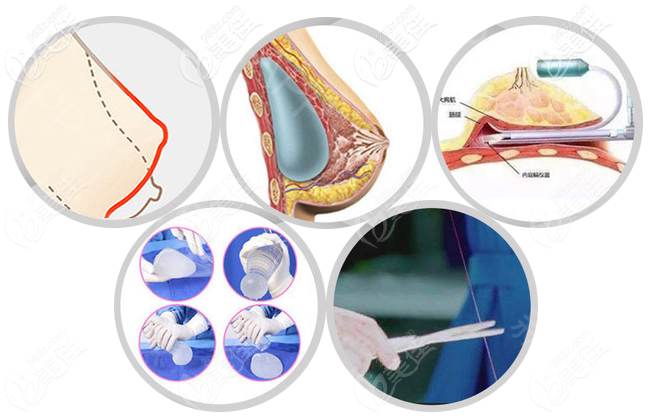 趙宏偉醫(yī)生隆胸技術(shù)怎么樣