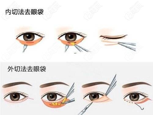 內切和外切去眼袋手術