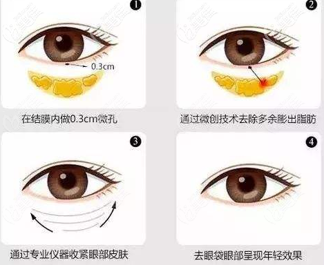 激光祛眼袋