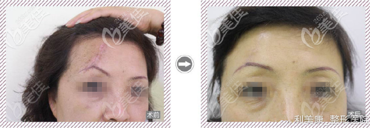 <!--<i data=20240703-sp></i>-->梁安裕祛疤痕案例 <!--<i data=20240703-sp></i>-->梁安裕祛疤痕案例