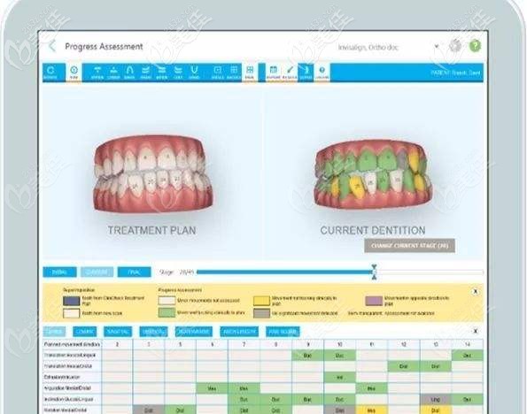 隱形矯正的數(shù)據(jù)要先上傳到云端