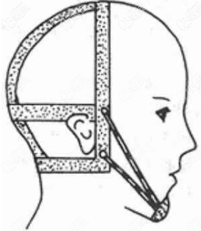 頭帽與牽引頦兜矯正裝置 頭帽與牽引頦兜矯正裝置