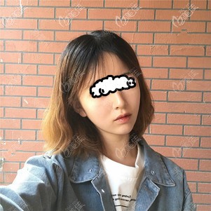 我到時光做自體脂肪填充面部,10天臉好圓,3個月后變成了心形少女臉