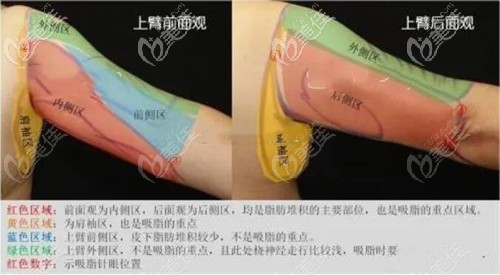 上手臂吸脂的位置 上手臂吸脂的位置