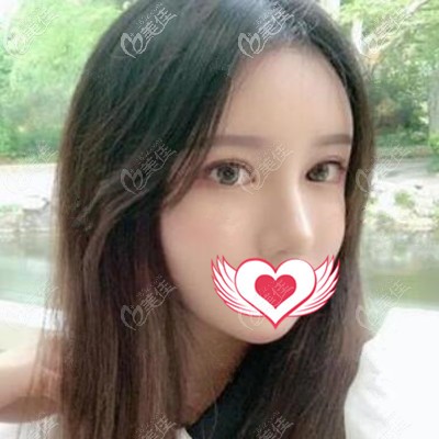 大連沙醫(yī)生整形吳紫權雙眼皮修復真人案例：術后2個月效果對比照展示！
