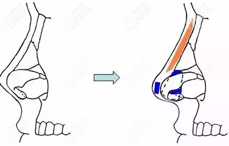 肋骨隆鼻失敗修復(fù)手術(shù)