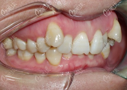 我矯正前的牙齒情況 我矯正前的牙齒情況