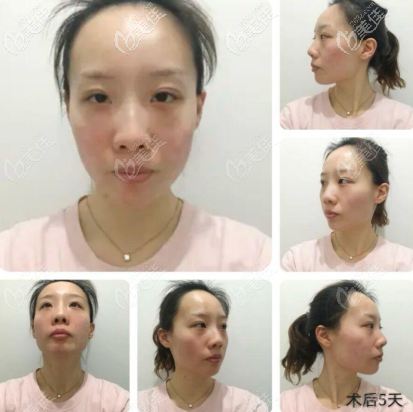 第五天臉還有點兒紅