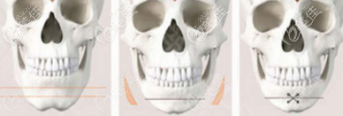 長臉縮短手術示意圖 長臉縮短手術示意圖