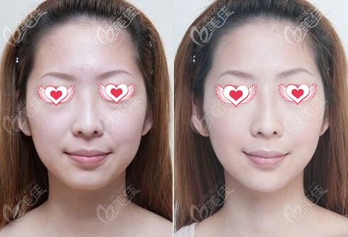 北京米蘭柏羽麗都石冰面部埋線提升真人前后對比照 北京米蘭柏羽麗都石冰面部埋線提升真人前后對比照