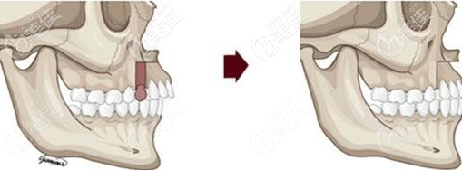 正頜手術(shù) 正頜手術(shù)