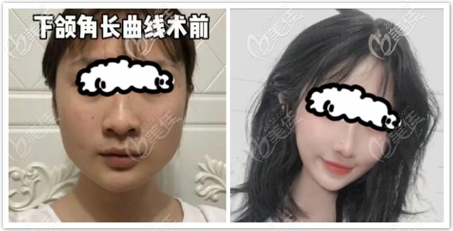 韓國磨骨醫(yī)生張柱允下頜角顴骨磨骨案例一年后效果對比圖 韓國磨骨醫(yī)生張柱允下頜角顴骨磨骨案例一年后效果對比圖