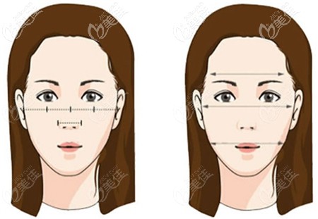 顴骨手術(shù)可以改善面部的比例