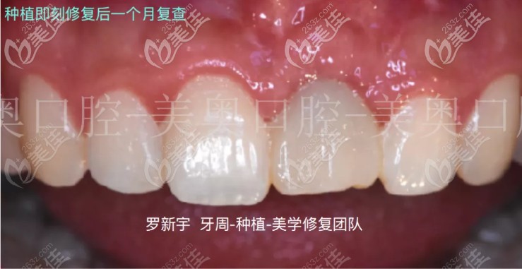 即刻種植一個(gè)月后的復(fù)查圖片 即刻種植一個(gè)月后的復(fù)查圖片