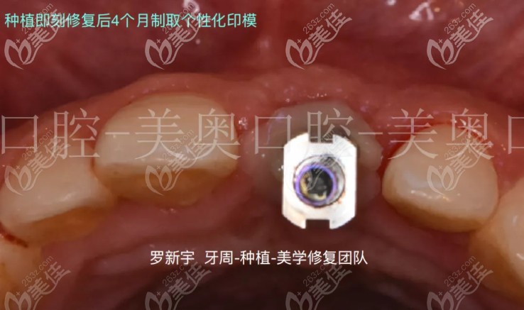 即刻種植4個(gè)月后的個(gè)性化印模 即刻種植4個(gè)月后的個(gè)性化印模